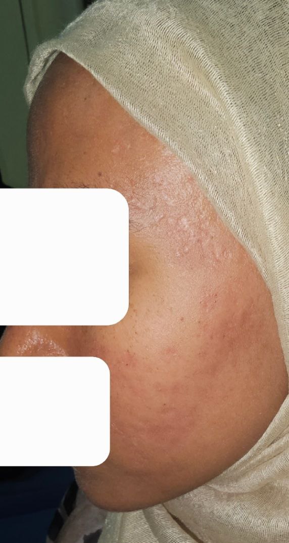 Reveal Your Glow: Why Chemical Peels and The Perfect Derma Peel™ Are Your Skin’s Best Friends